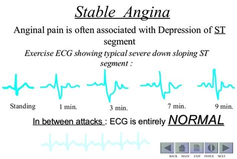 Stable Angina Vs Unstable Angina Ecg : Unstable Angina Pathophysiology Definition Stemi And ...