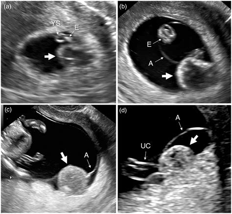 Chorionic bump: Progression to a subamniotic hematoma - Claudia Galleguillos, Waldo Sepulveda, 2022