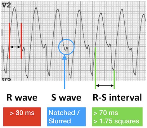 ECG VT V2 S wave notch Josephson sign 700 Cath Lab Nursing, Cardiology Nursing, Cardiac Nursing ...