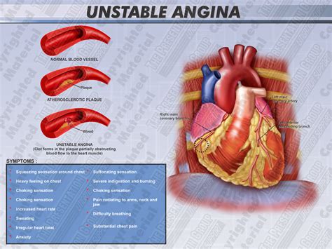 Pin on stable unstable prinzmetal angina