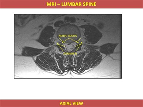 Mri