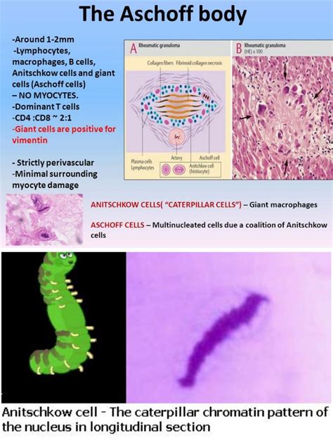 Antiscchkow cell and Aschoff cell ... #Macrophage | Collagen fibers ...