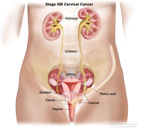 Cervical Cancer Treatment (PDQ®)–Patient Version - Siteman Cancer Center