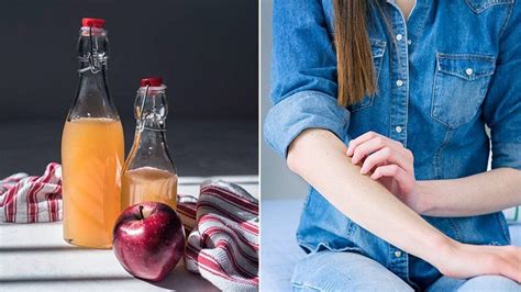 Can Apple Cider Vinegar Improve Eczema and Atopic Dermatitis?