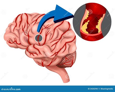 Blood Clot Concept In The Brain Stock Image - Image: 34202961