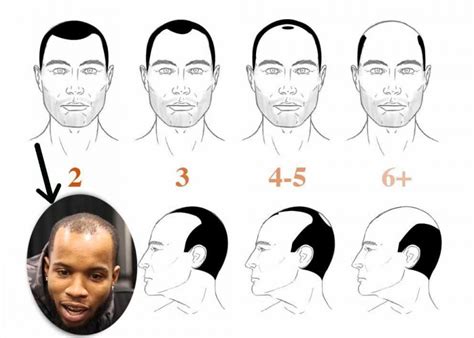 Tory Lanez Hair Transplant - Hair Analysis by Matt Dominance