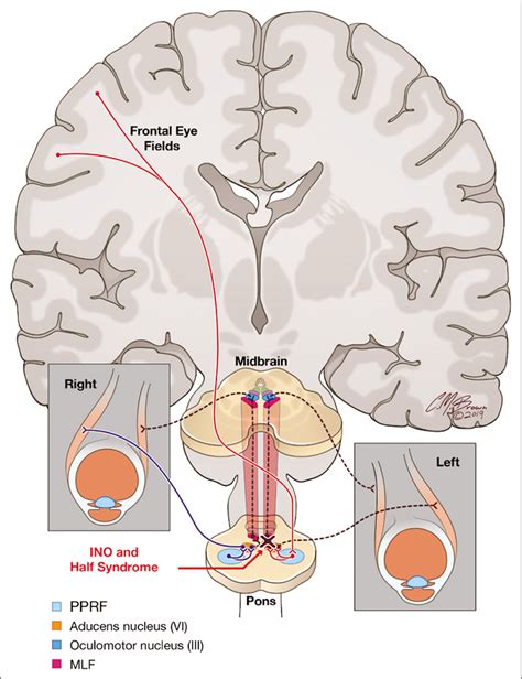 An Anatomic, Imaging, and Clinical Review of the Medial Longitudinal Fasciculus - Journal of ...