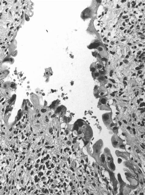 Pathology Outlines - Radiation atypia