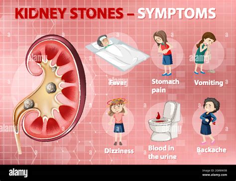 Kidney stones symptoms cartoon style infographic Stock Vector Image ...