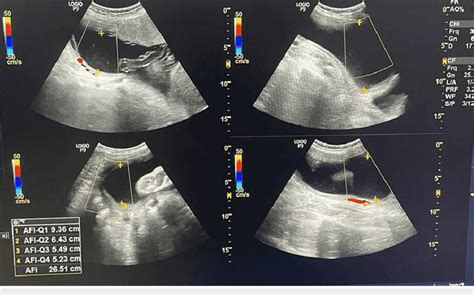 USG Image showing AFI at 32 weeks of gestation for the second patient ...