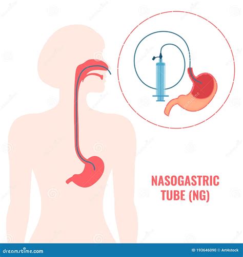 Nasogastric Tube. The Liquid Feeding By Insert NG Tube Passes Th Cartoon Vector | CartoonDealer ...