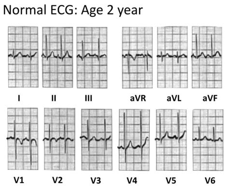 Normal paediatric ECG • LITFL • ECG Library Diagnosis