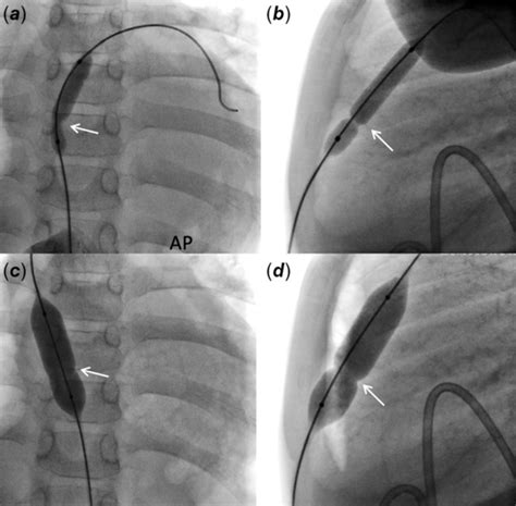 Single center experience of pediatric percutaneous balloon pericardiotomy | Cardiology in the ...