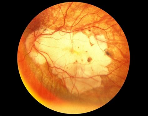 Myopic Macular Degeneration - Retina Image Bank