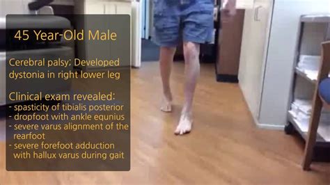 Richie Brace® Case Study - 45 Year Old Male - Cerebral Palsy & Dystonia - YouTube