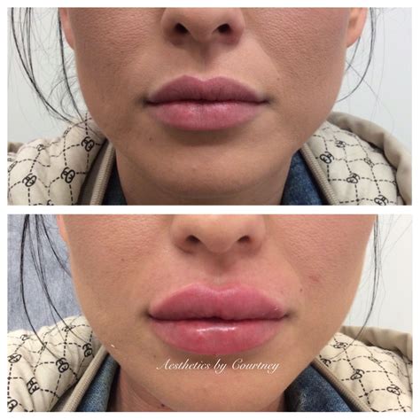 #LipFillersBruising #LipFillersStyles | Lip injections, Lip fillers, Natural lip plumper