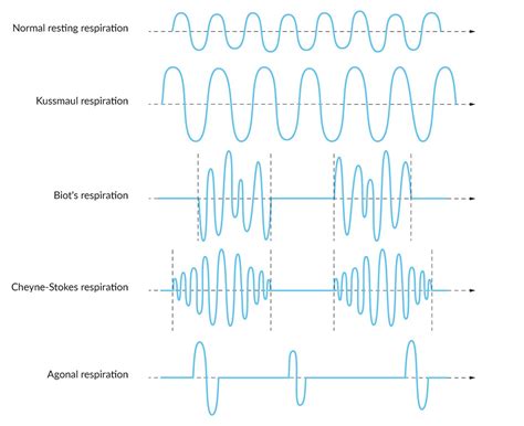 Kussmaul Breathing Pattern