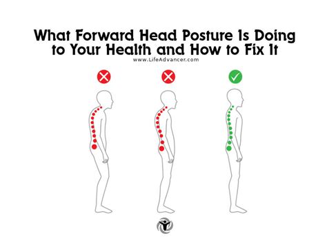 What Forward Head Posture Is Doing to Your Health and How to Fix It