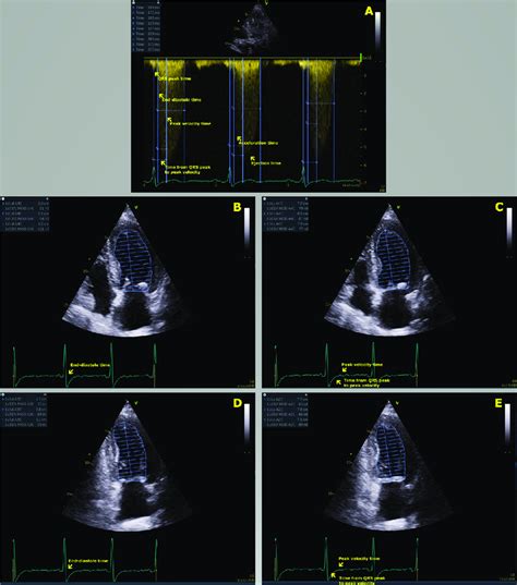 Measurement of first-phase ejection fraction in a single patient: (A)... | Download Scientific ...