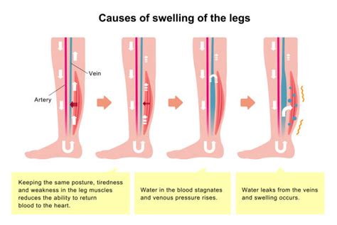 Weeping Leg Edema Causes