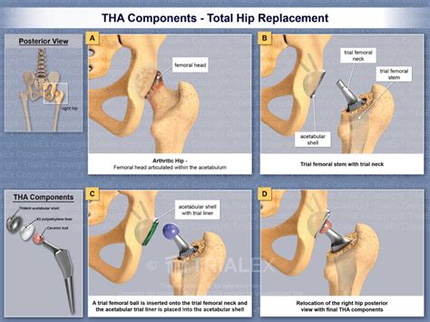 THA Components - Total Hip Replacement - TrialQuest Inc.