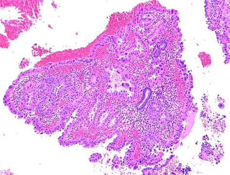 Clear Cell Carcinoma of the Endometrium | Endometrial biopsy… | Flickr