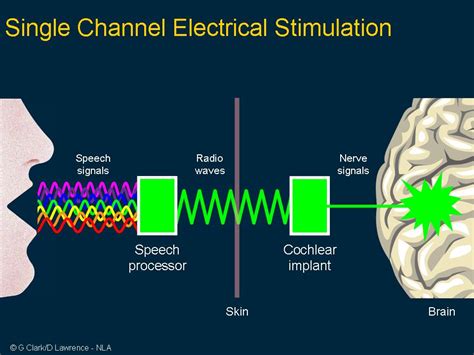 How the cochlear implant (bionic ear) functions - Graeme Clark Foundation