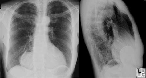 Learning Radiology - Pericardial Cyst