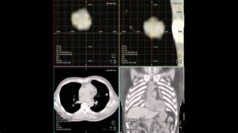 Moving lung tumor during imaging (radiation therapy) - YouTube