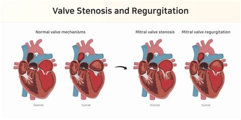 Valvular Heart Disease: What are the different types - Pulse Cardiology