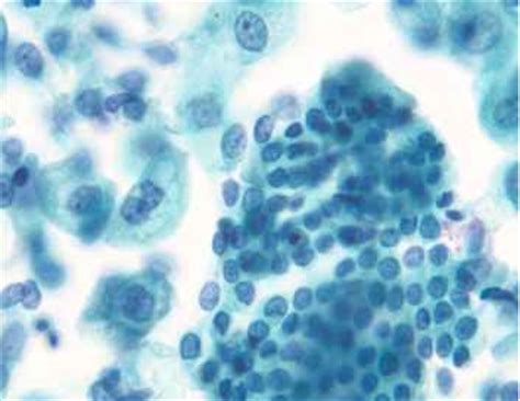 Atypical Urothelial Cells Indeterminate for Neoplasia - Urothelial Cells