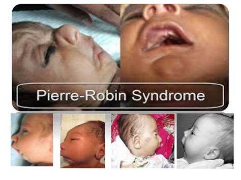 Pierre Robin Syndrome