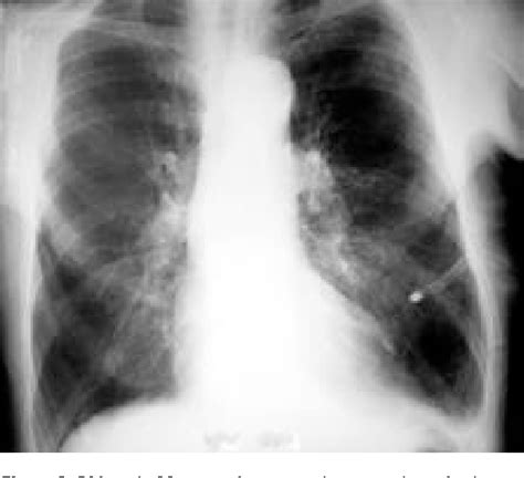 Figure 1 from Talc slurry pleurodesis via chest tube in department of ...