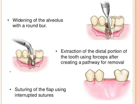 Principles and steps of surgical tooth extraction