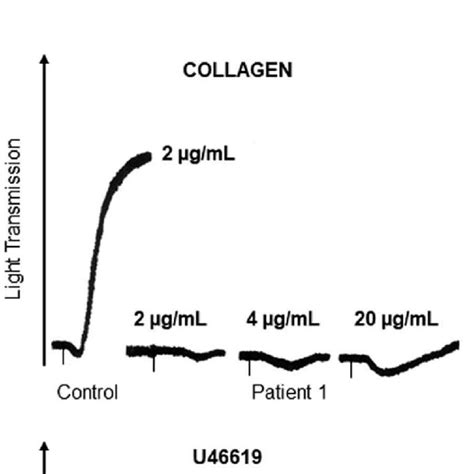 Platelet aggregation of patient 1 and the control.Representation of ...