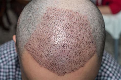 Facts and Myths of Hair Transplant Surgery – GLC Aesthetics