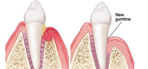 Periodontal Surgery in Millburn | Millburn Pocket Reduction ...