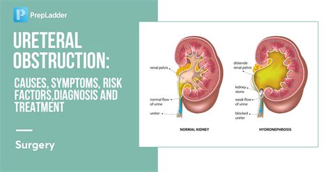 Ureteral Obstruction: Causes, Symptoms, Risk Factors, Diagnosis and ...