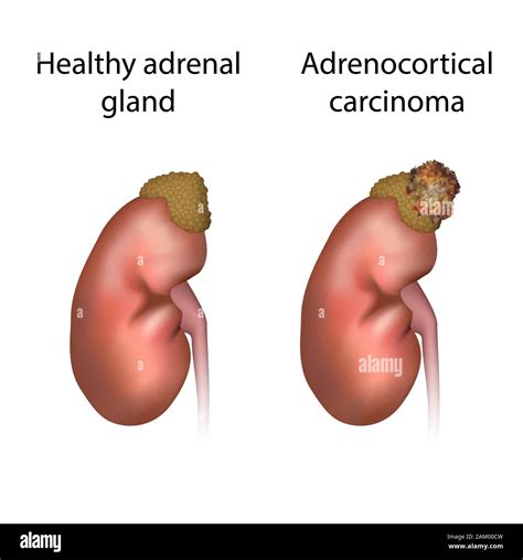 Adrenal gland disorder Cut Out Stock Images & Pictures - Alamy