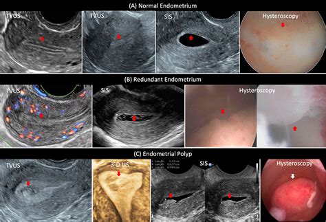 Abnormal Transvaginal Ultrasound