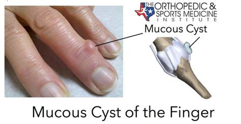 Mucous Cyst of the Finger