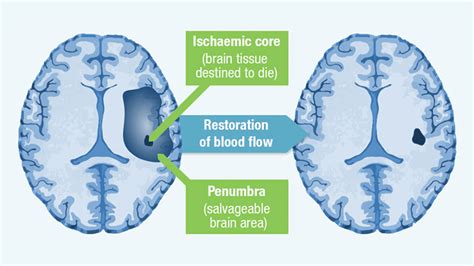 Pathophysiology of Stroke | Strokeforum