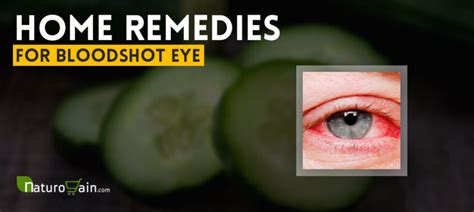 10 Best Home Remedies for Bloodshot Eye to Prevent Red Eyes [Fast]