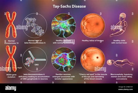 Illustration of Tay-Sachs disease, a genetic disorder that ...