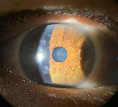 Conductive keratoplasty iris scars : r/optometry