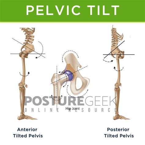 Posterior Pelvic Tilt