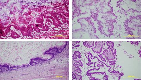 (200x) Upper Left: Frozen Section examination of a mucinous borderline... | Download Scientific ...