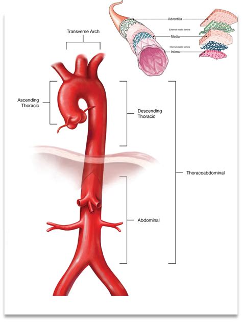 Ascending Thoracic Aortic Aneurysm