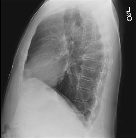 Diffuse idiopathic skeletal hyperostosis - wikidoc