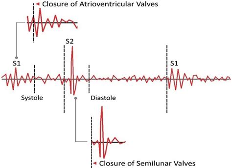 Representation of phonocardiogram (PCG) signal. | Download Scientific ...